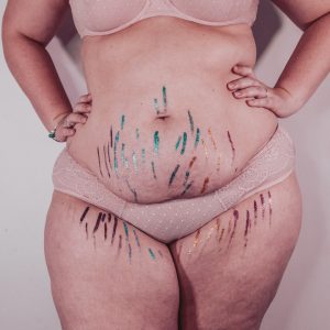 Stretch marks due childbirth